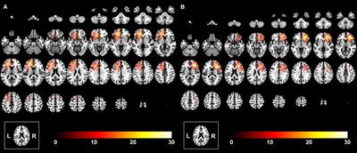 Decreasing Shortest Path Length of the Sensorimotor Network Induces Frontal Glioma-Related  Epilepsy